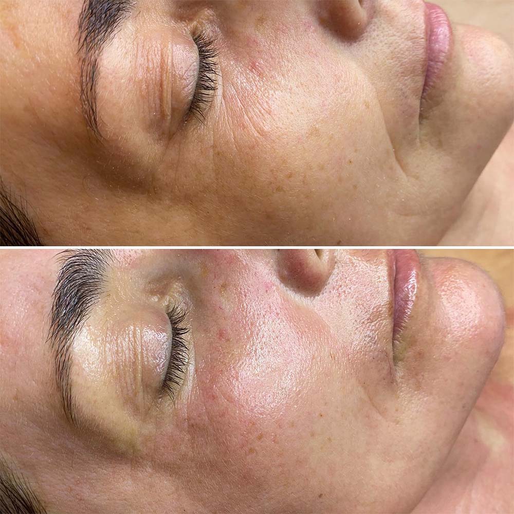 What Happens to Signs of Aging After 1 Session of Microneedling?