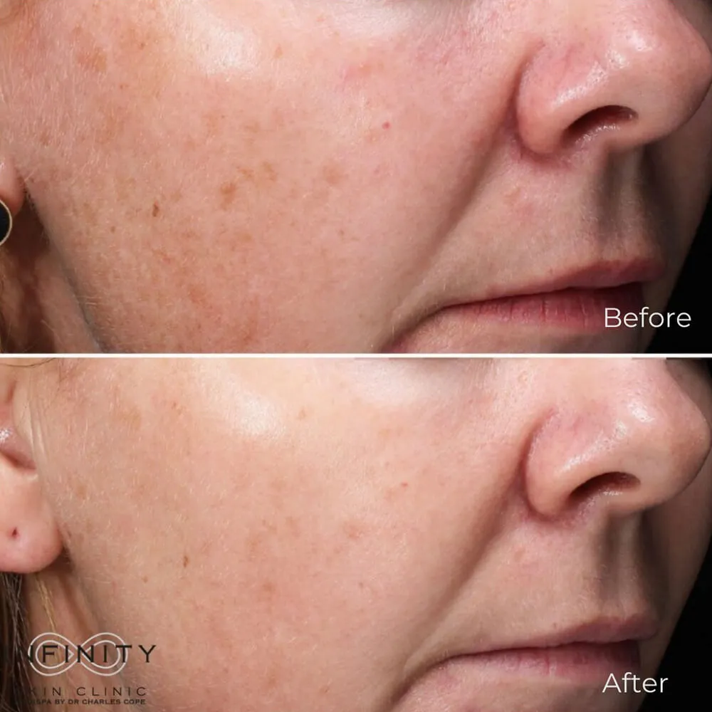 microneedling aftercare instructions