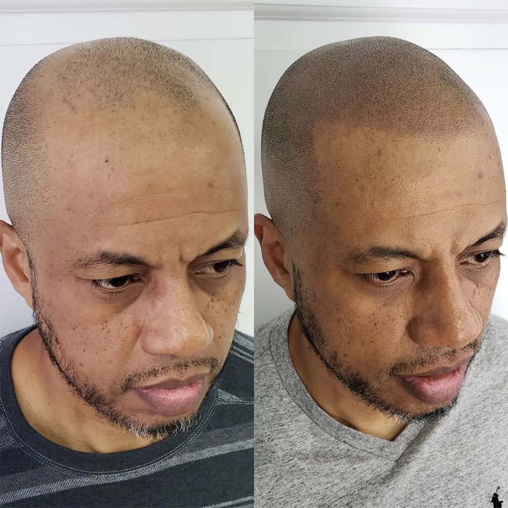 SMP Treatments Pattern Baldness Alopecia Hair Transplant Scar