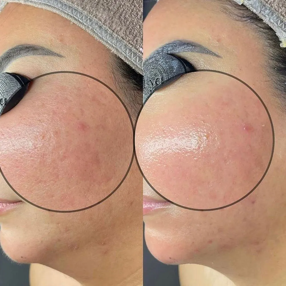 Hydradermabrasion Facial Is Suitable For Everyone