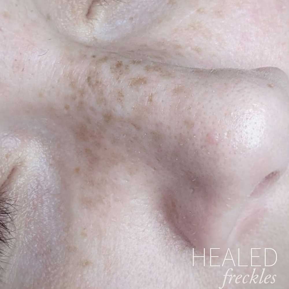 all tattooed and fully healed freckles