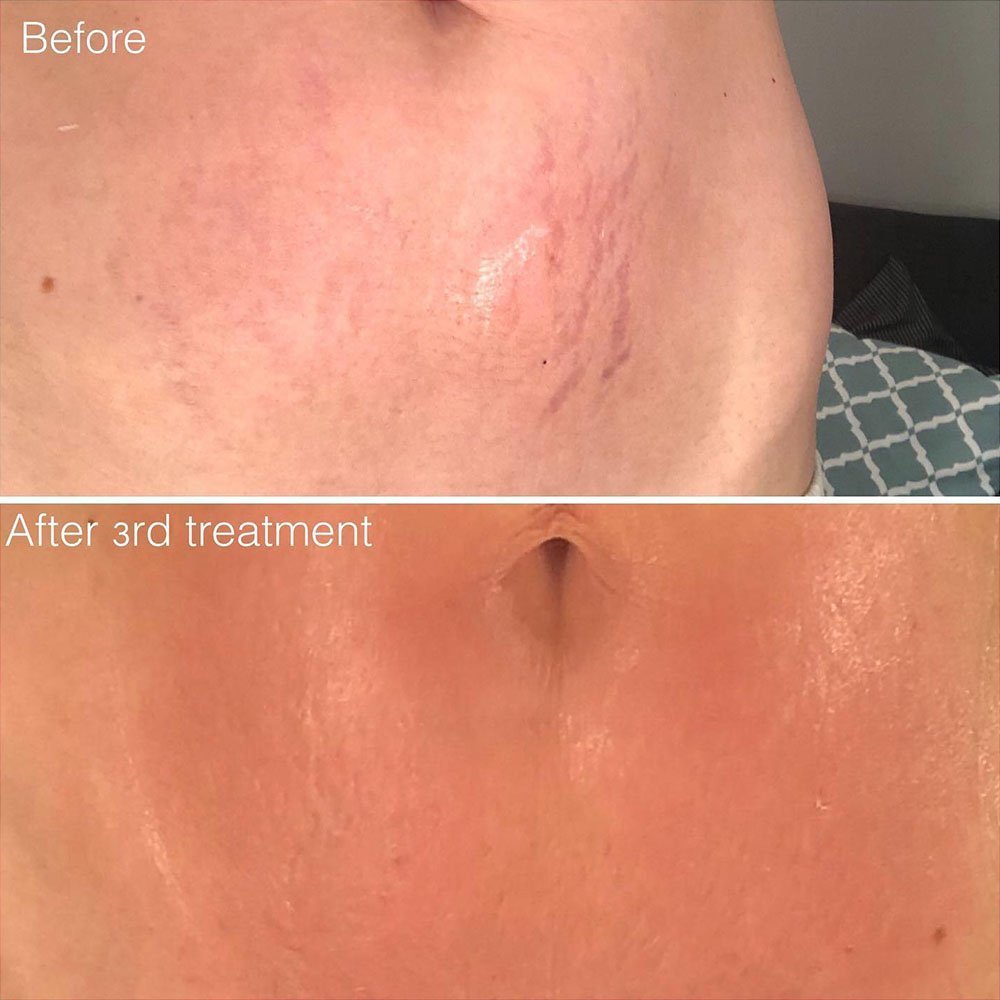 belly stretch marks microneedling procedure