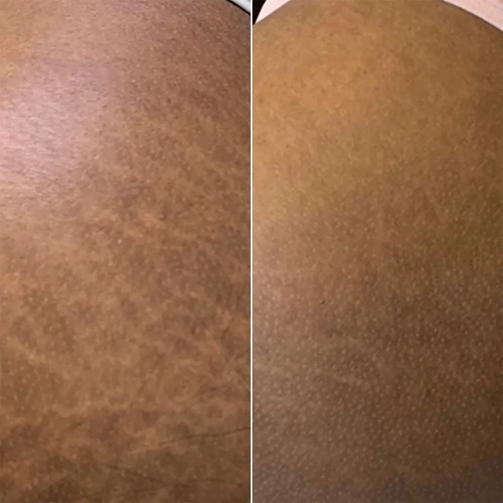 microneedling stretch marks