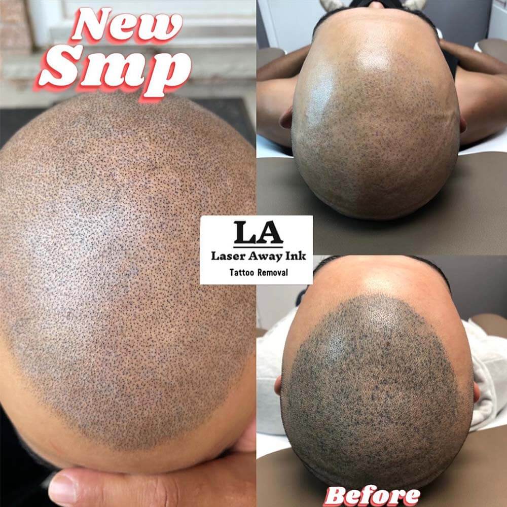scalp micropigmentation gone wrong smp removal