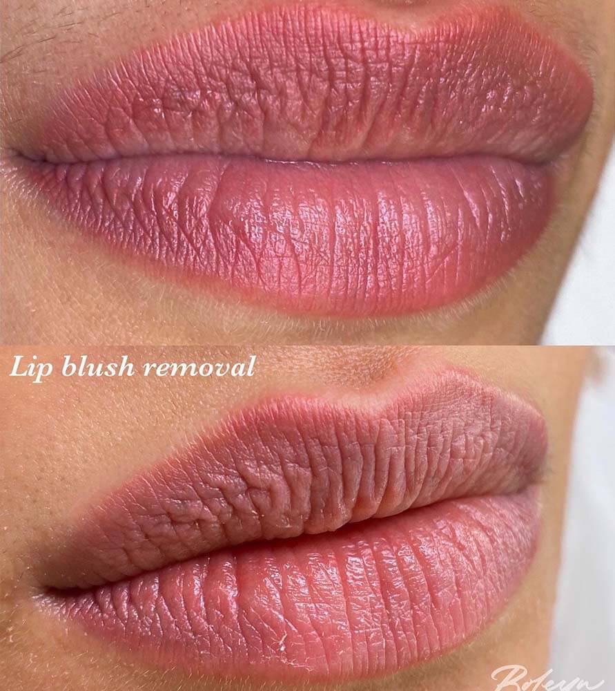 unwanted pigment lip tattoo removal