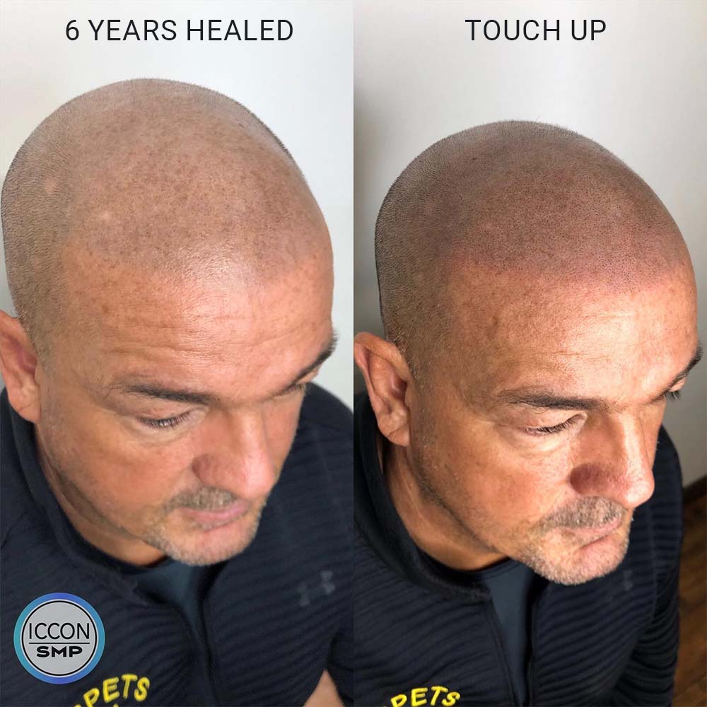 scalp micropigmentation after 5 years