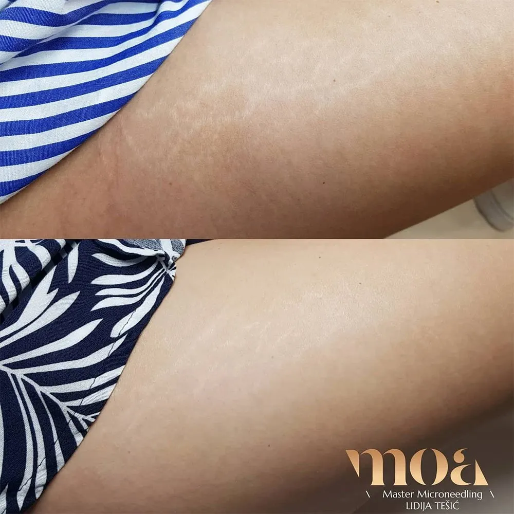 Microneedling Stretch Marks - Does It Work and How?