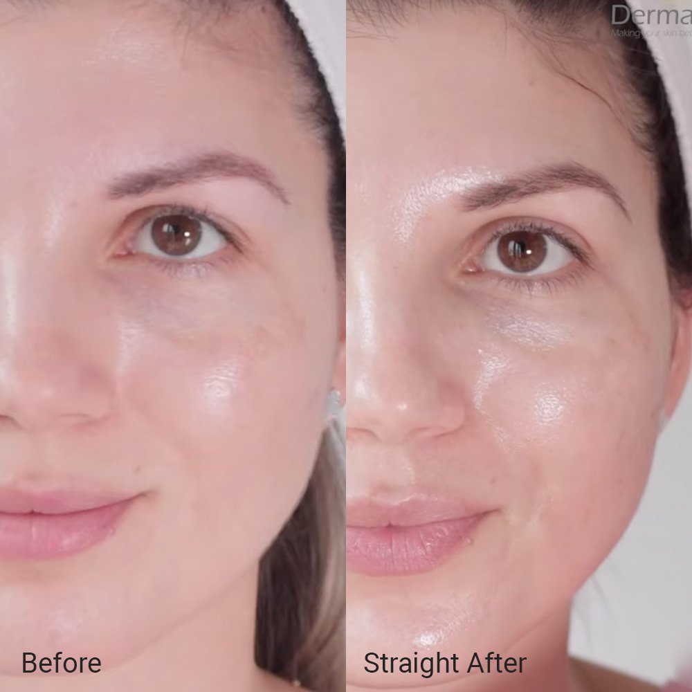 Microdermabrasion at-home treatment