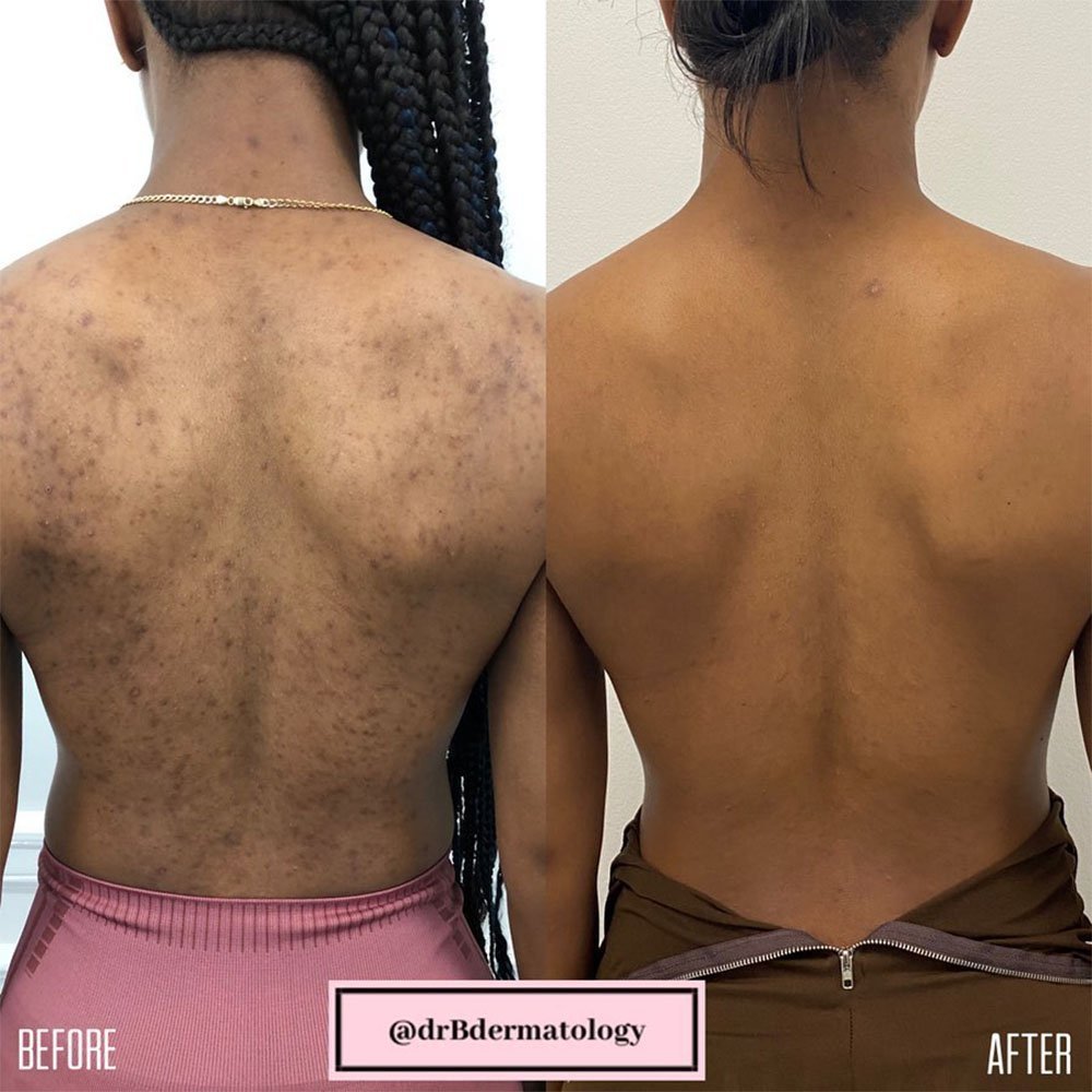 body chemical peel on a back