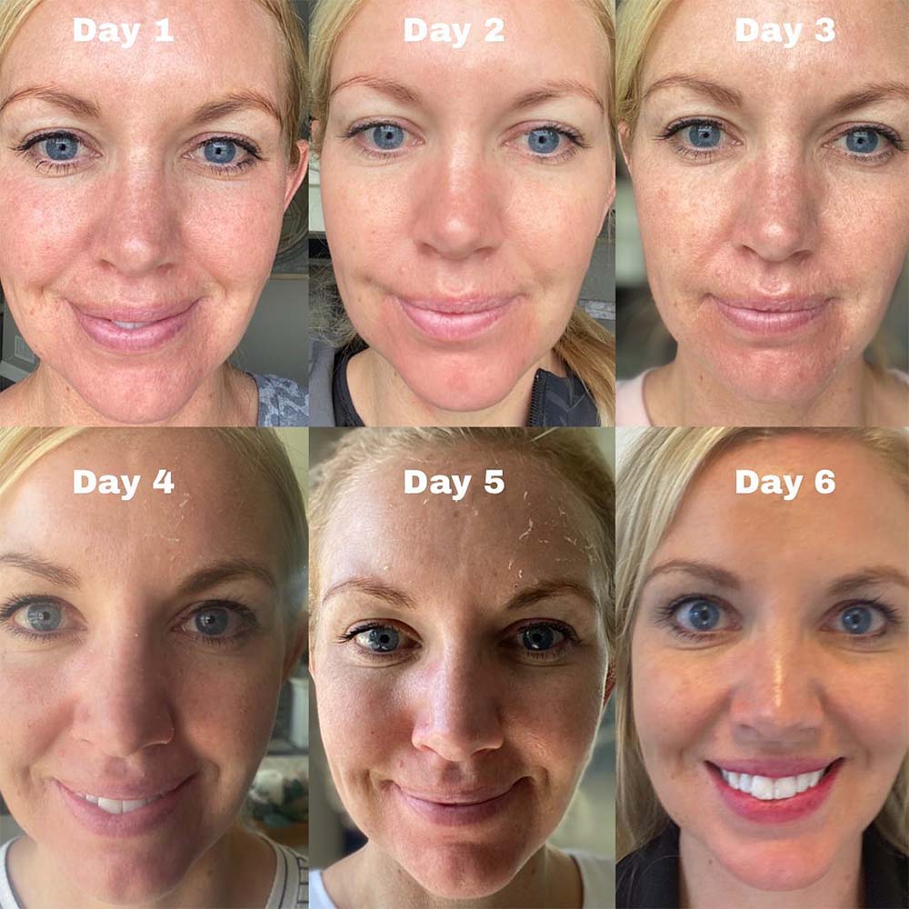 chemical peel process day by day