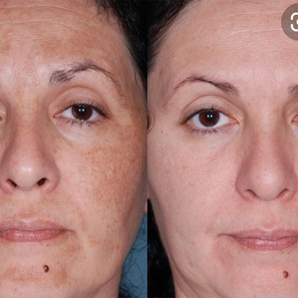 light chemical peel