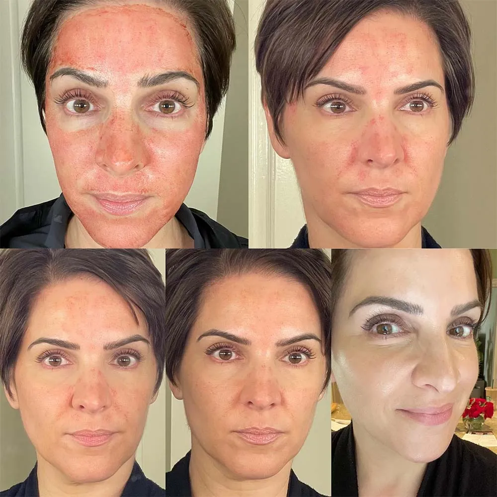 bleeding during microneedling treatment