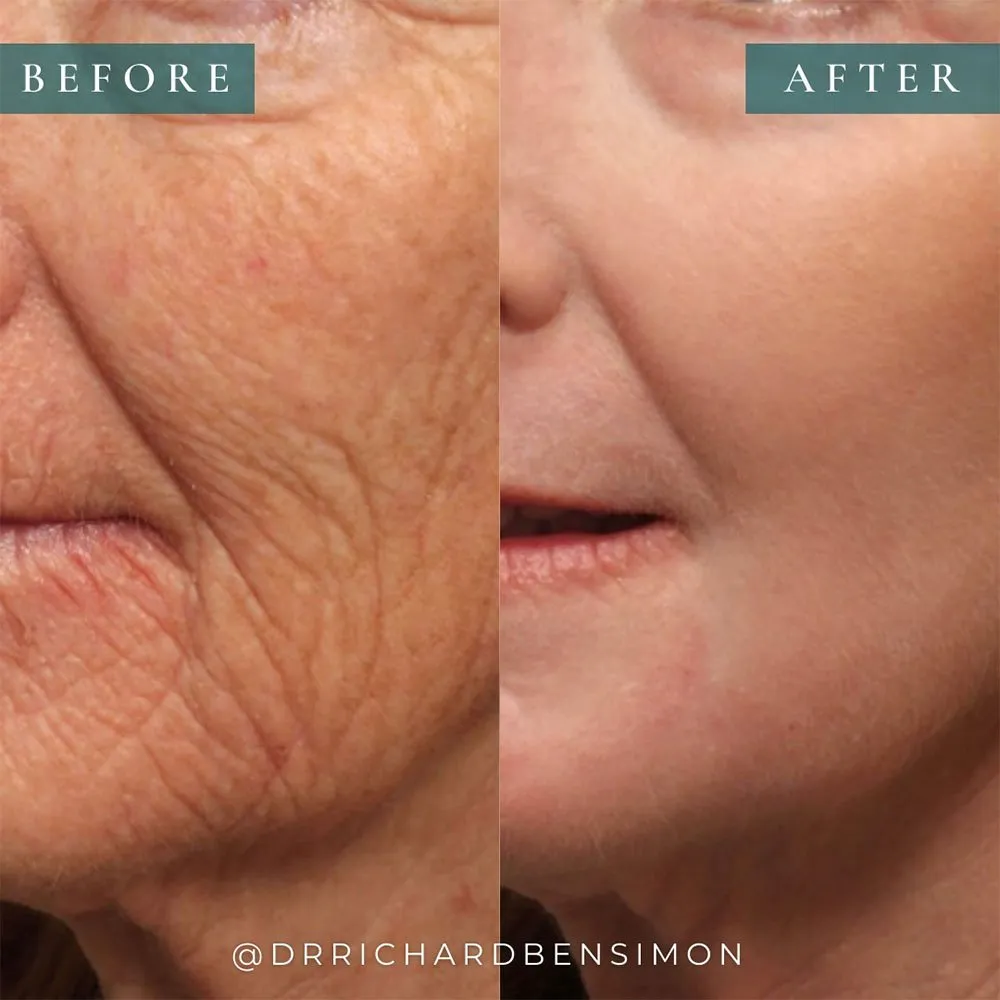 intensity of chemical peel 