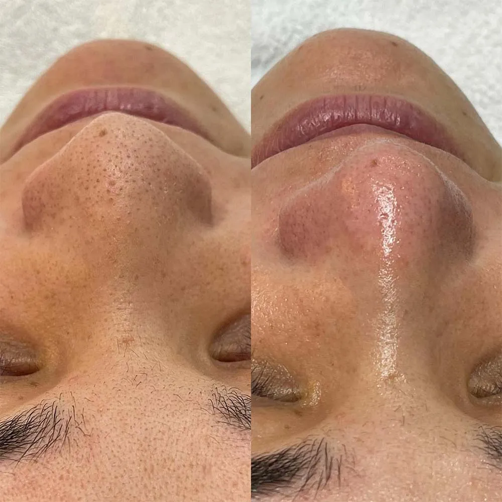 What Can Microdermabrasion for Blackheads Do?
