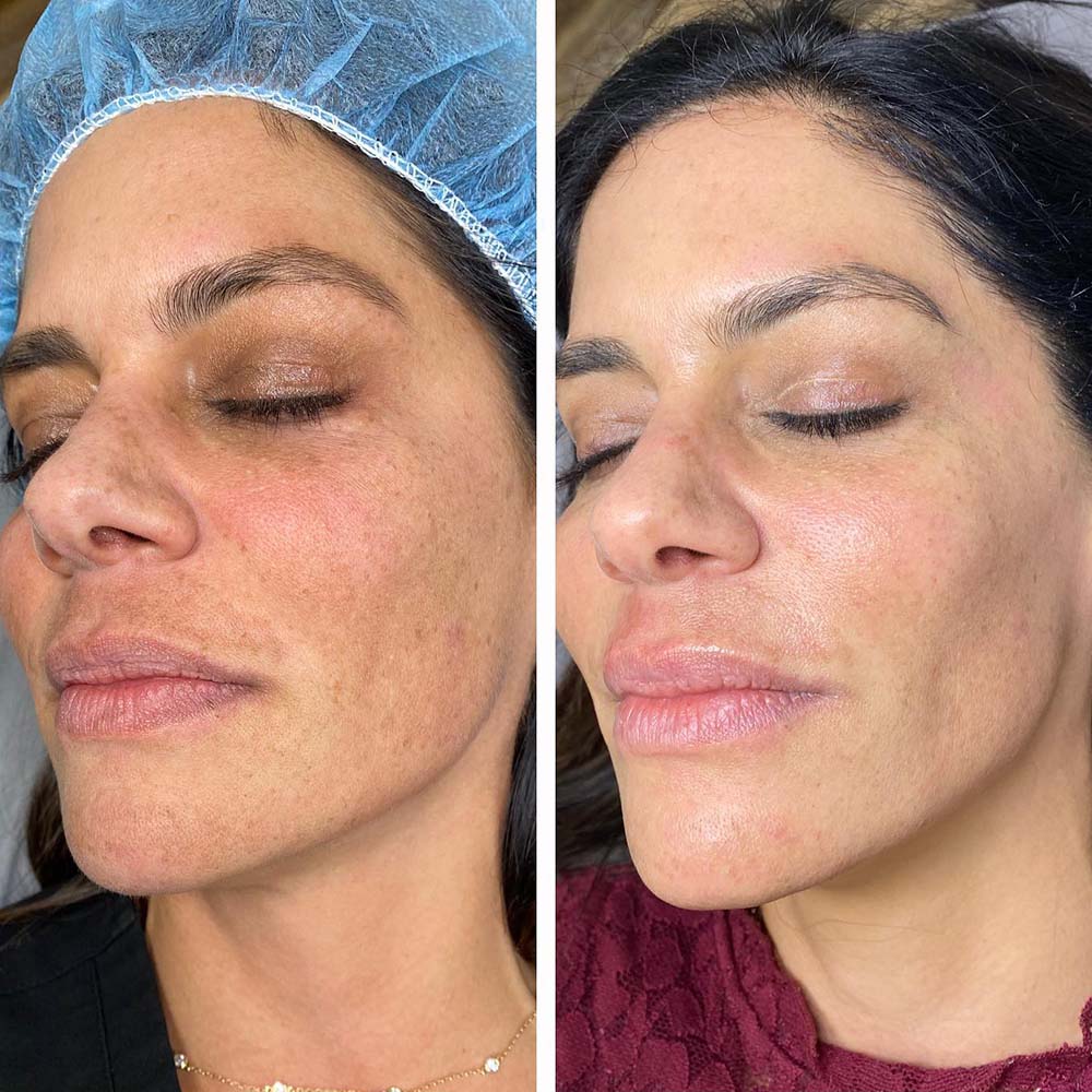 Woman before and after chemical peel