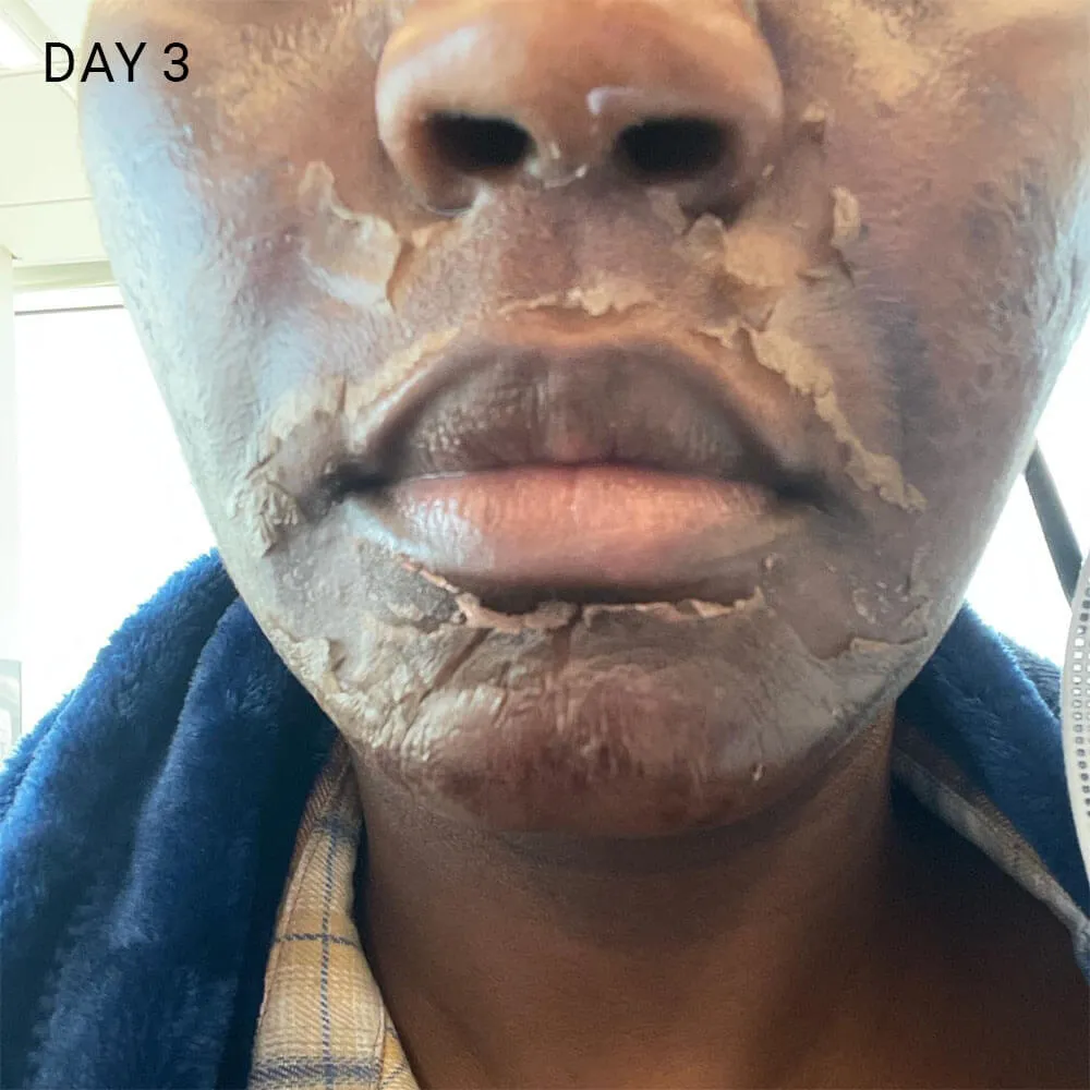 chemical peel day 3 peeling of the skin starts
