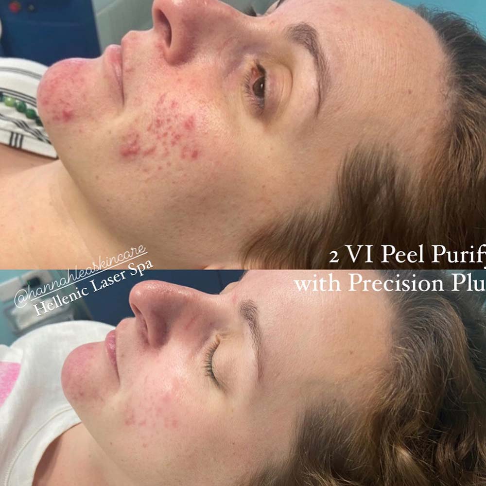 Results of chemical peel for acne scars