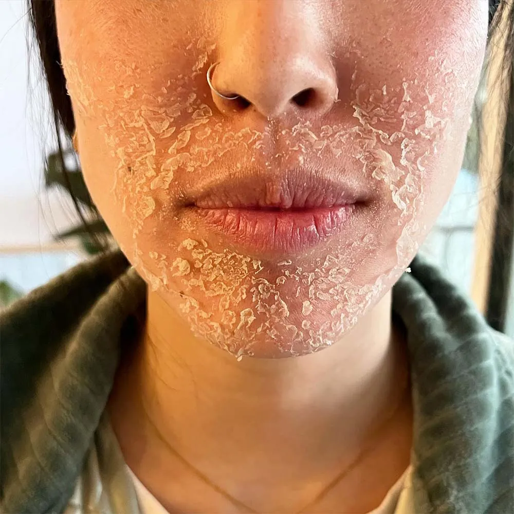 Skin healing after chemical peel
