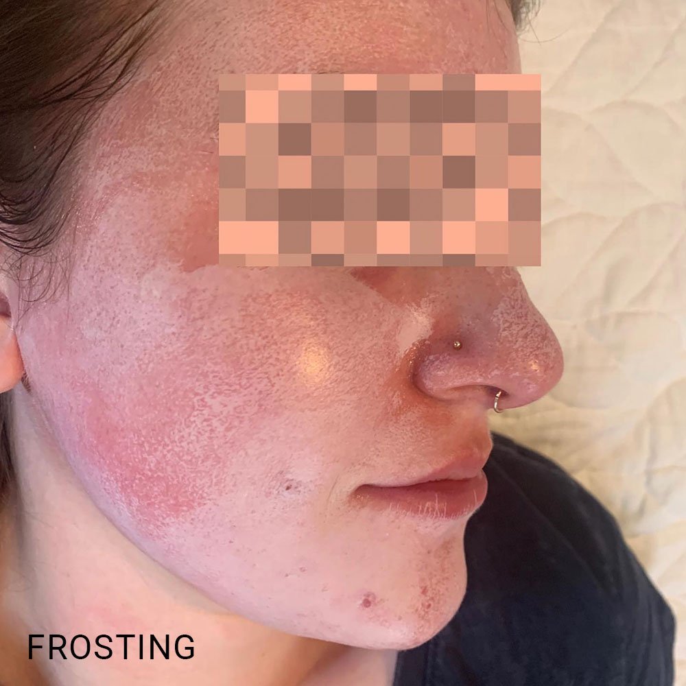 chemical peel redness and frosting
