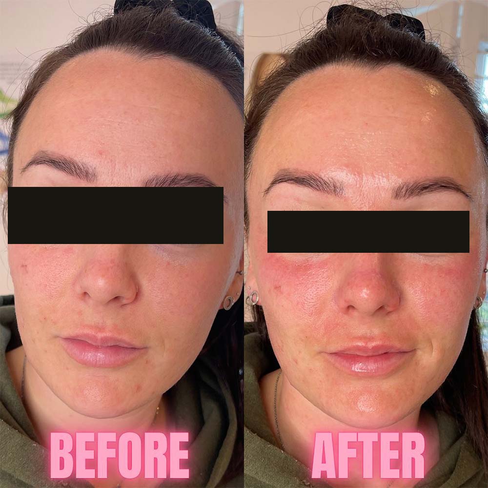 Redness after chemical peel