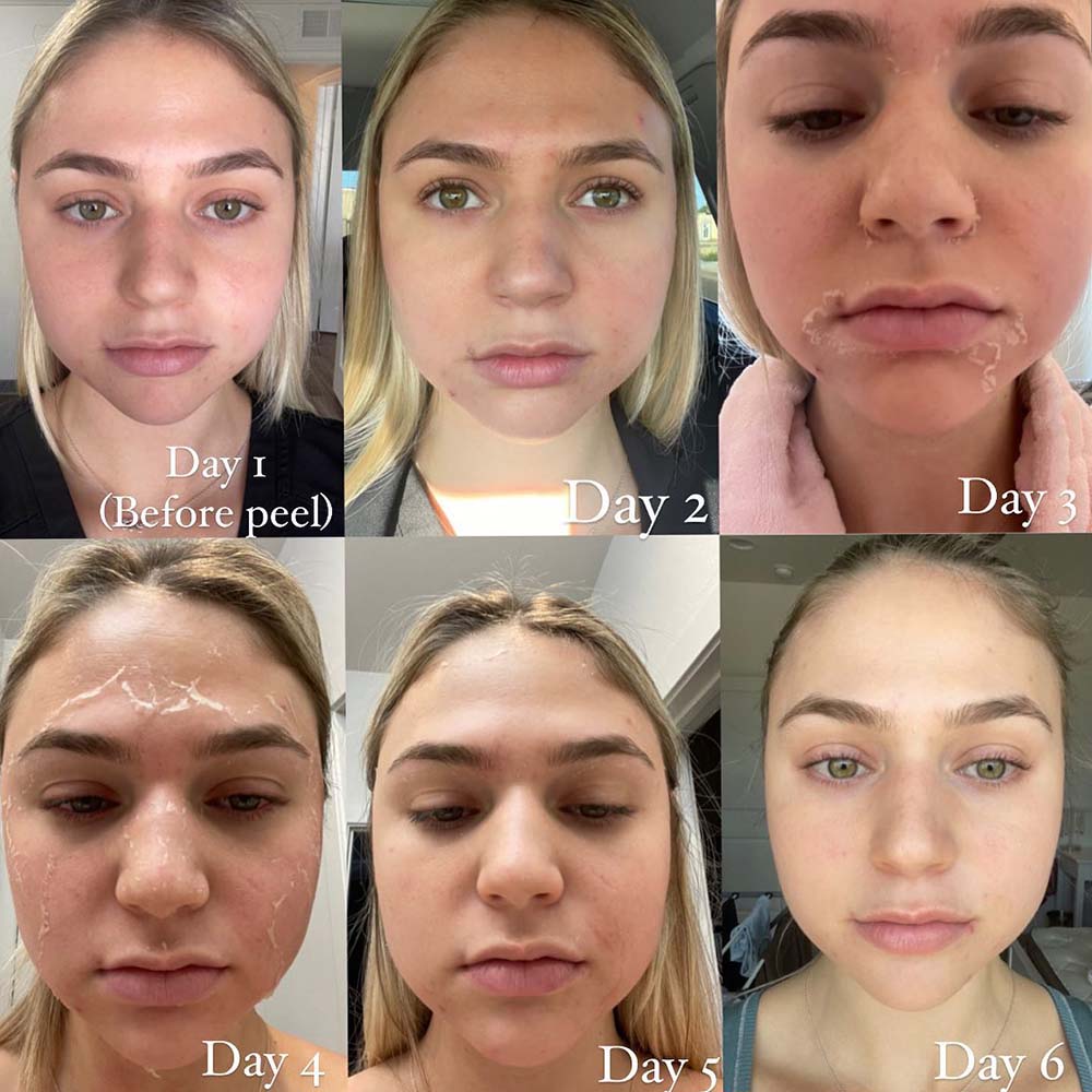 day by day chemical peel recovery