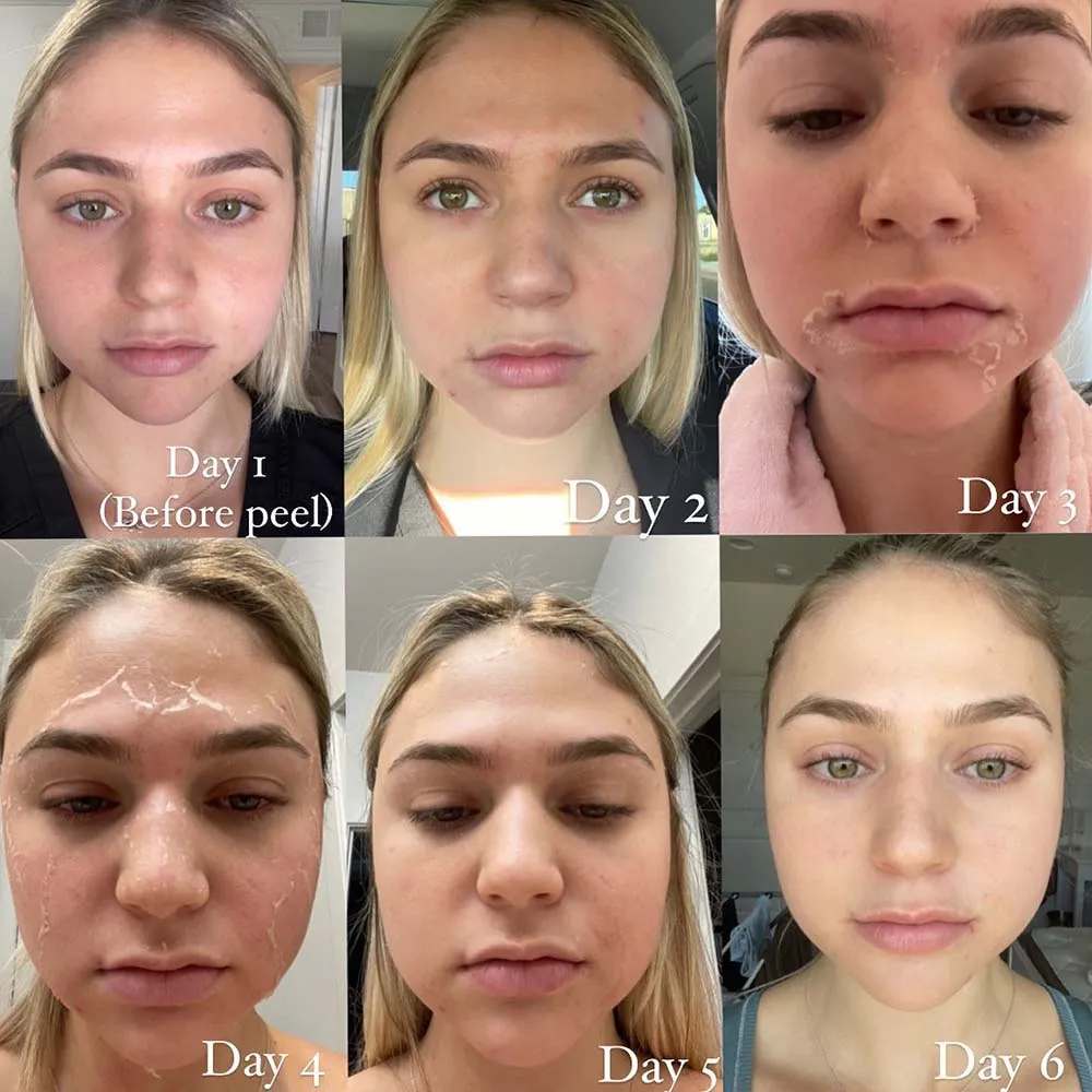 Getting a Chemical Peel? Here Are Some Tips to Prepare Before the Procedure