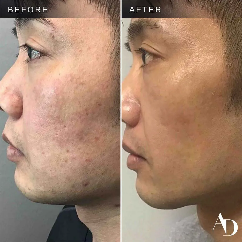 How Long After Microneedling Can I Get a Chemical Peel?