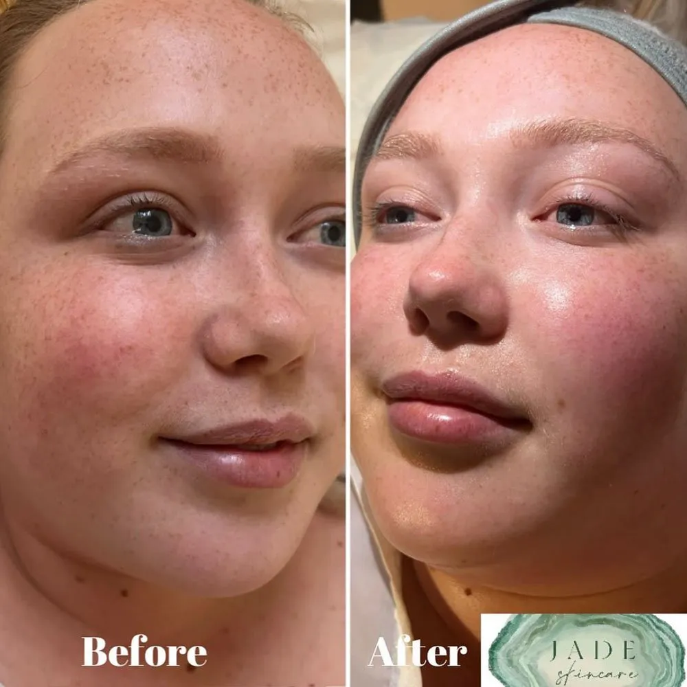 Does Microdermabrasion for Hyperpigmentation Work