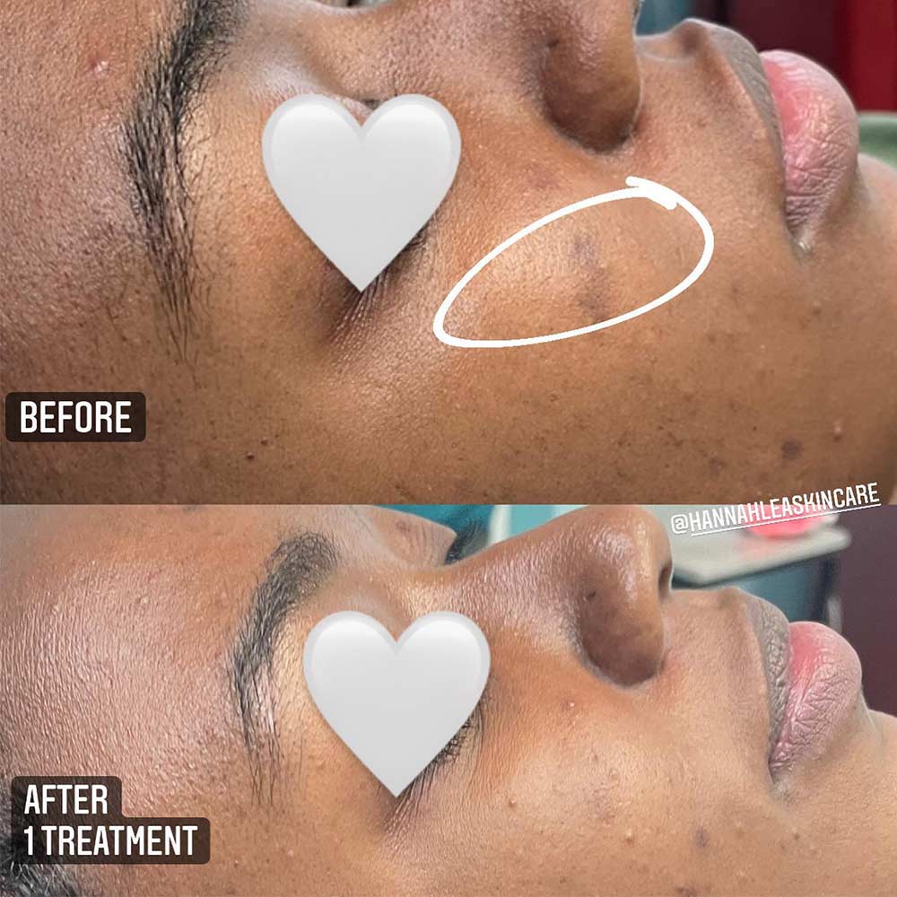 Results of chemical peel for hyperpigmentation