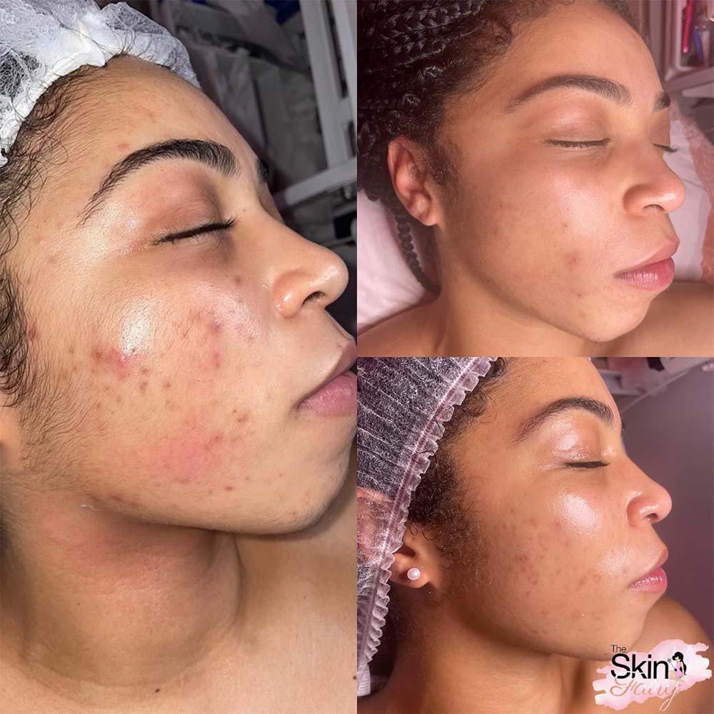 Results after a combination of chemical peel and microneedling