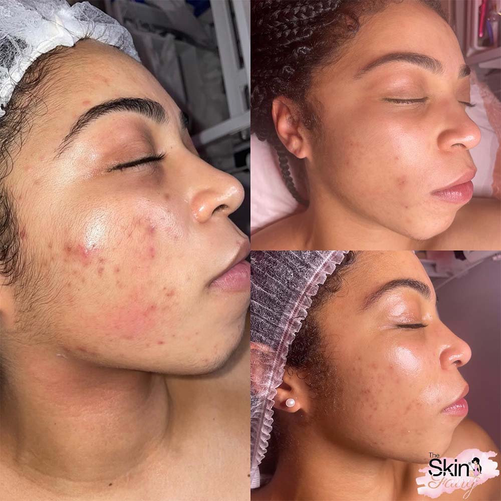 Results after a combination of chemical peel and microneedling