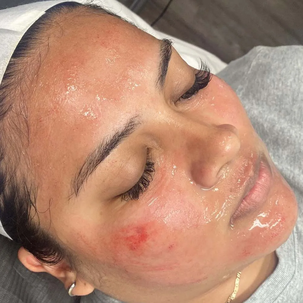 Woman immediately after microneedling
