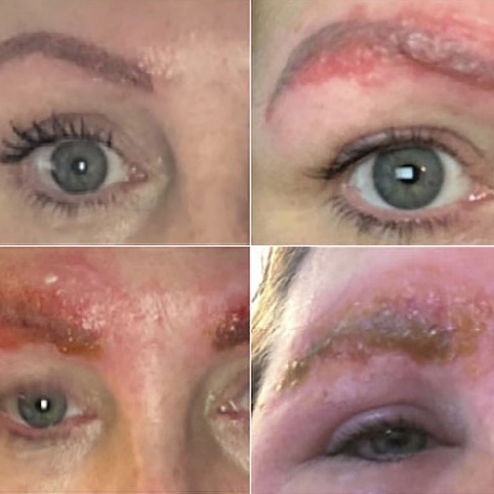 Signs of microblading infection