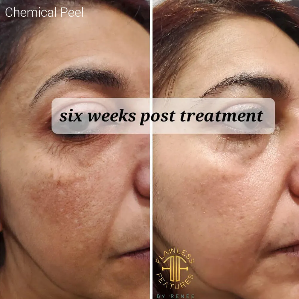 condition you want to treat with chemical peel