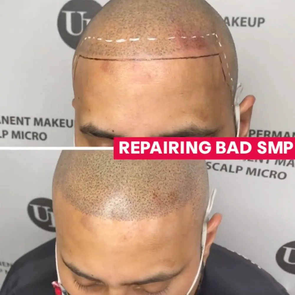 Video  Bad Hair Tattoo Before and After Repair on Pasadena Patient