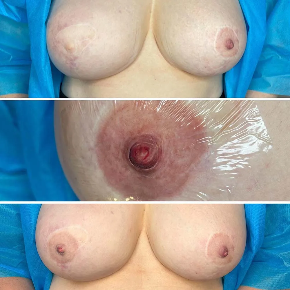 Nipple and areola tattoo 