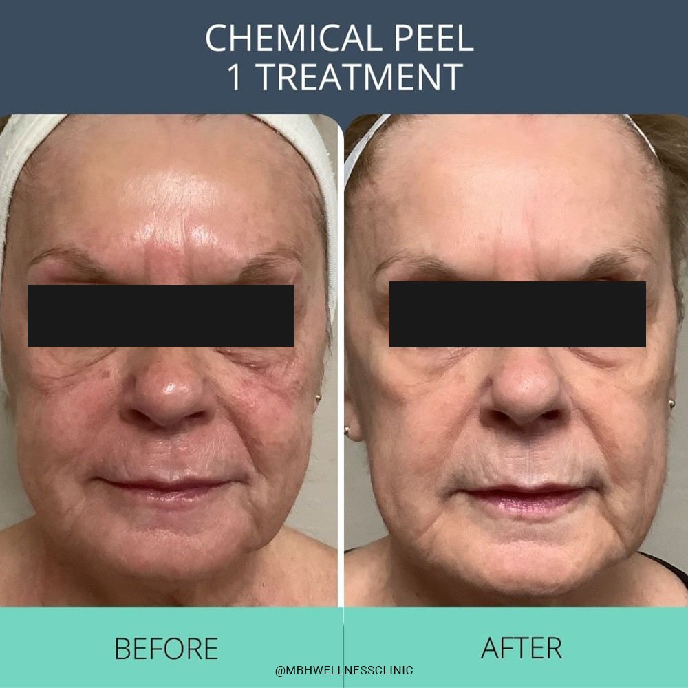 chemical peel recovery skin appearance