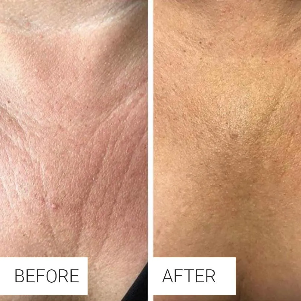 is microneedling painful on the body