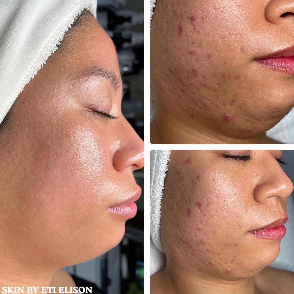 RF Microneedling