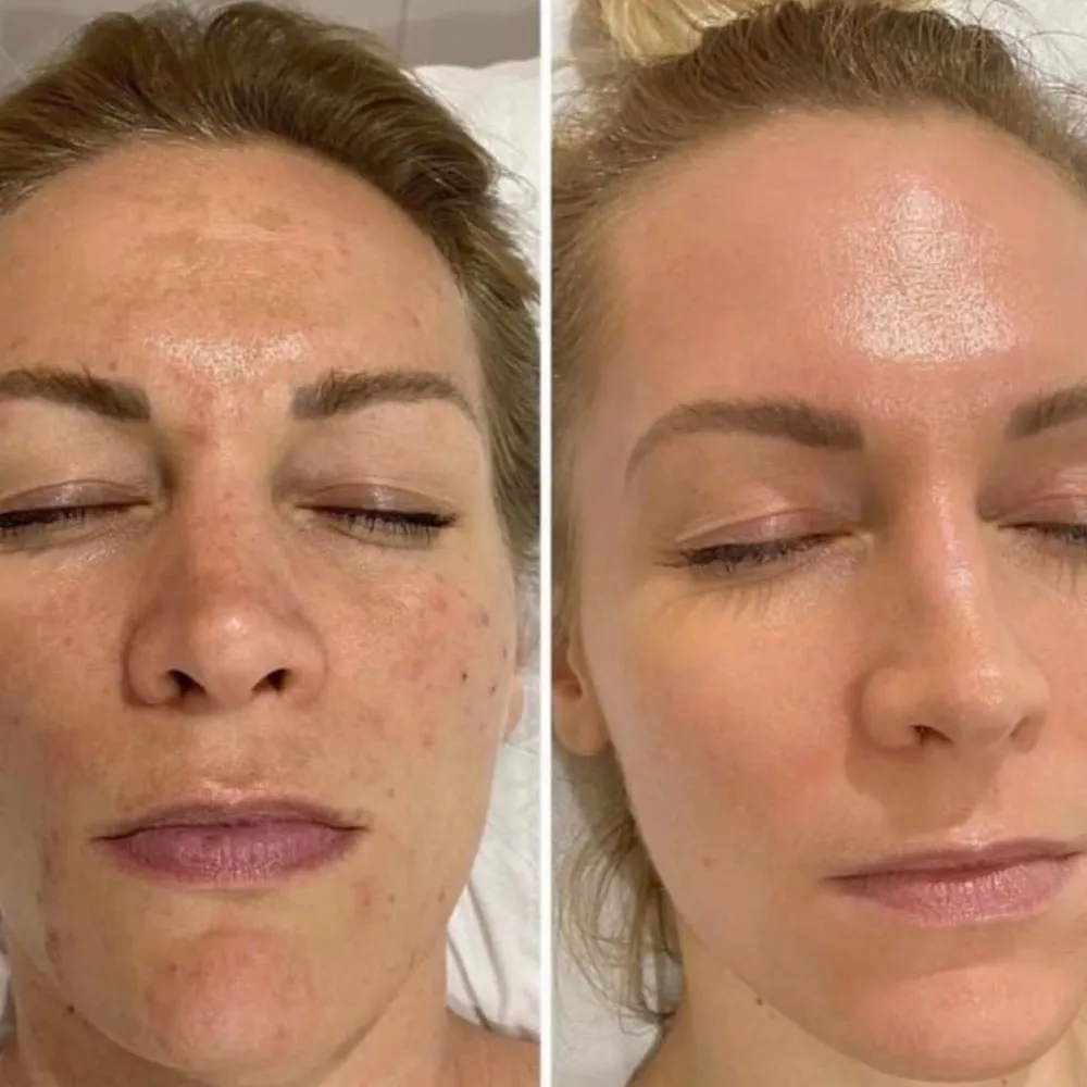 what does a chemical peel do