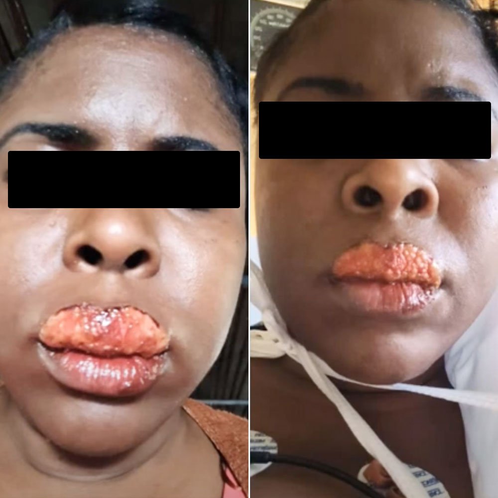 lip tattoo infection