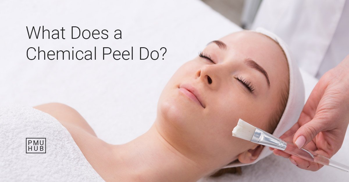 what-does-a-chemical-peel-do-image