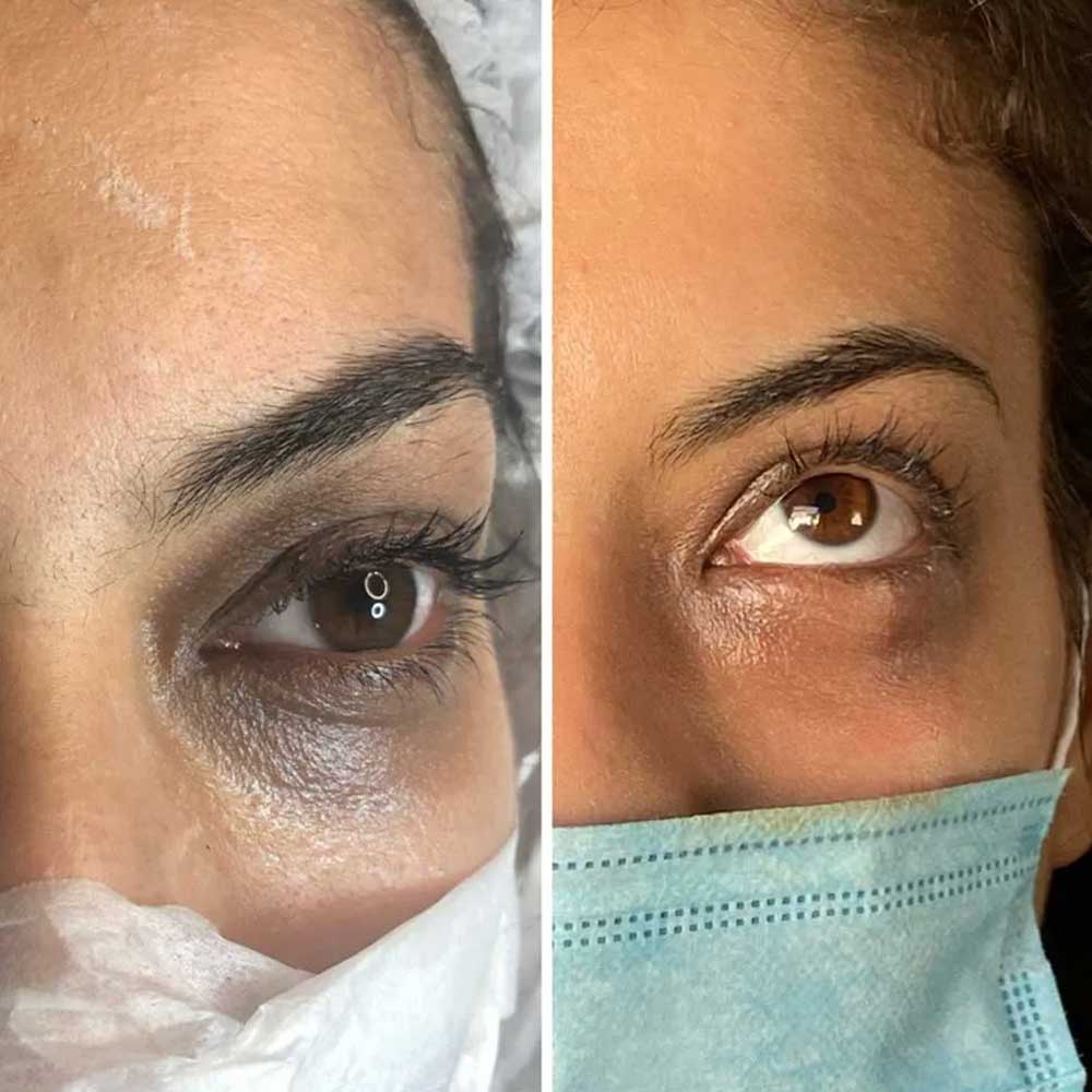 Permanent Concealer Before and After Pictures Gallery