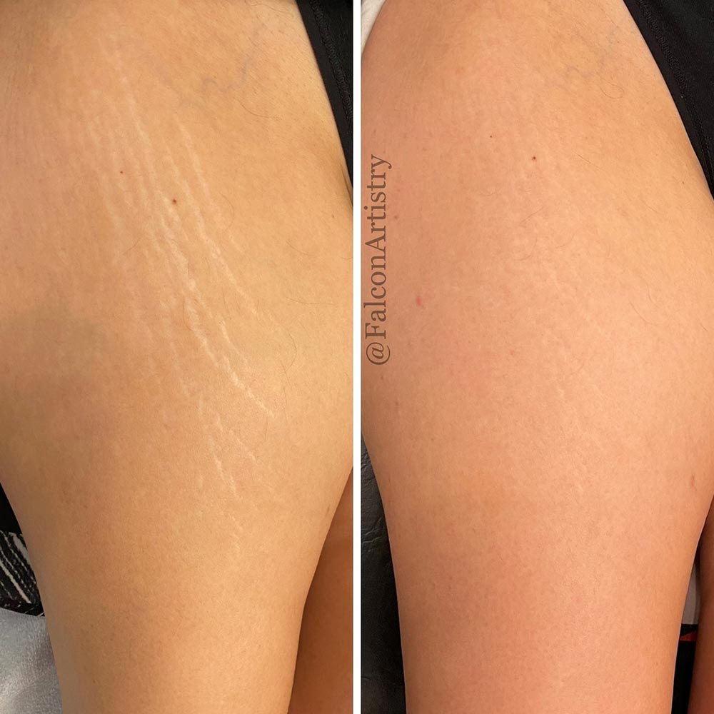 What Is Stretch Mark Camouflage and Should You Try It?