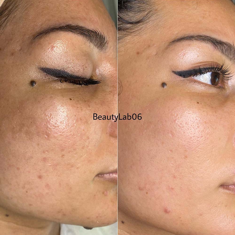 Results of microneedling acne scars