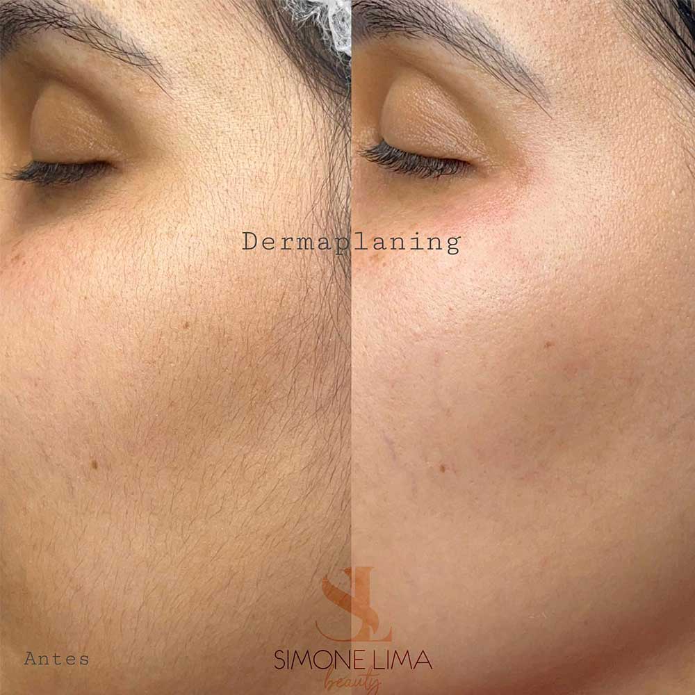 dermaplaning facial effects