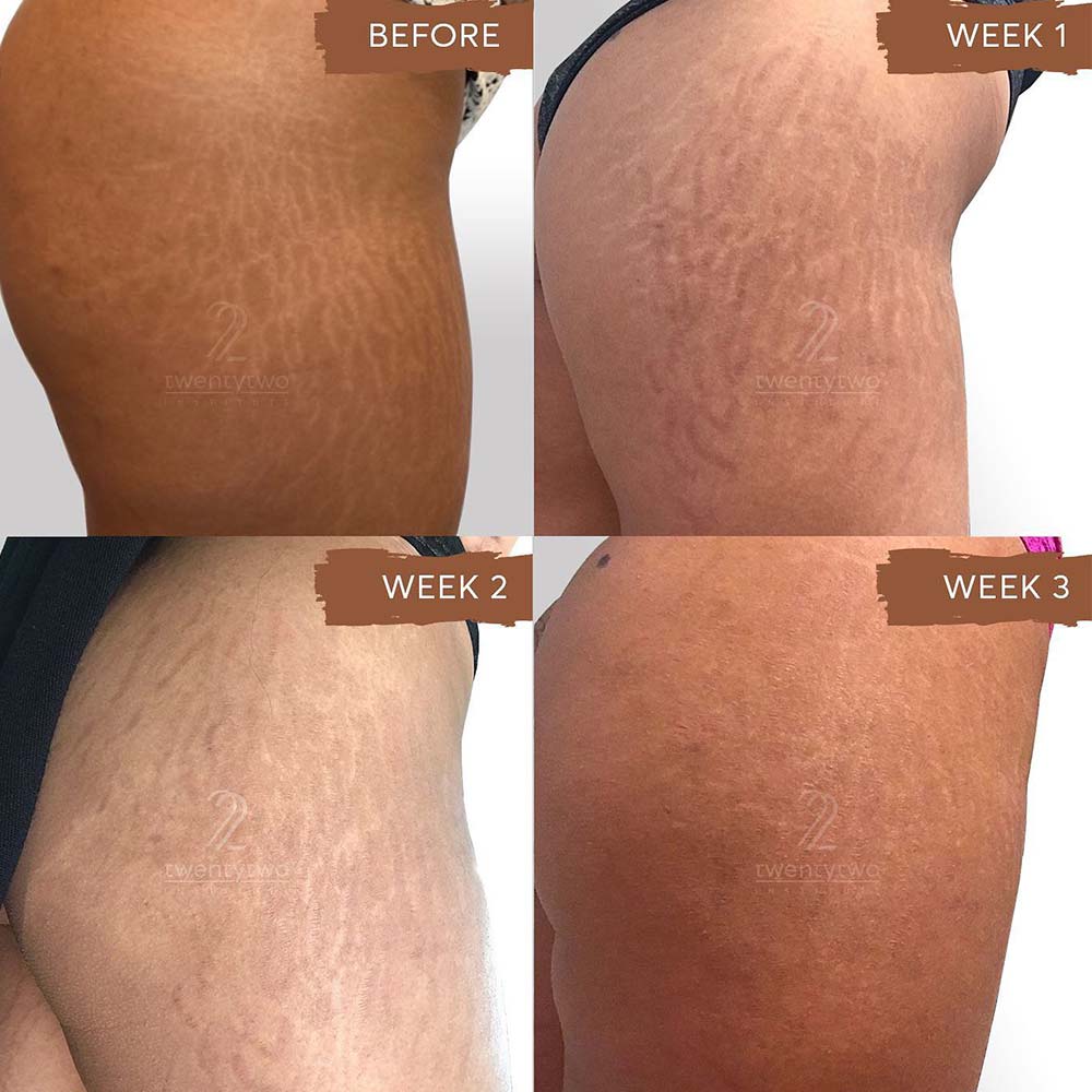 Stretch Mark Camouflage  Removal   Glamour Gains Studio  Facebook