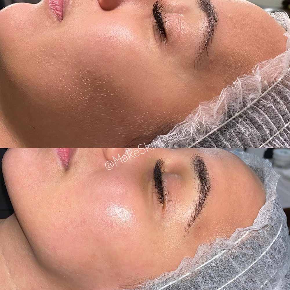 Results of professional dermaplaning