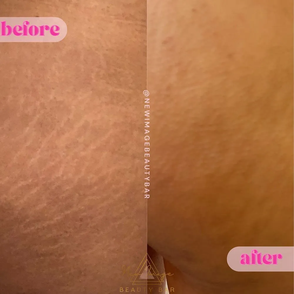 How to Get Rid of Surgical Scars? - New Image Beauty Bar