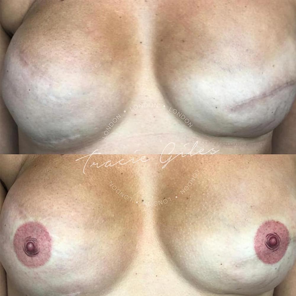 breast scar camouflage